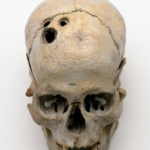 trepanação