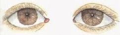 mióse - Avaliação das pupilas: conheça sua importância