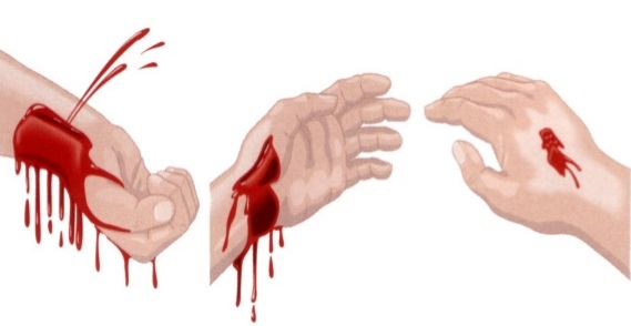 hemorragia - Termos Técnicos Sistema Circulatório