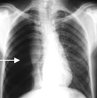 pneumotorax - Termos Técnicos Sistema Respiratório