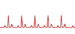 taquicardia sinusal 150x68 - hemostasia