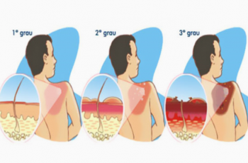Queimaduras: Conheça seus Tipos e os Cuidados de Enfermagem