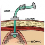 Nutrição enteral