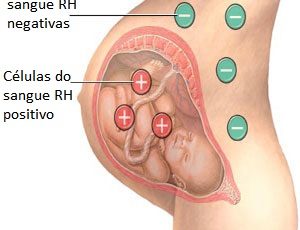 Eritroblastose Fetal 