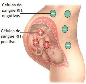 Eritroblastose Fetal  - Quais são os Tipos Sanguíneos