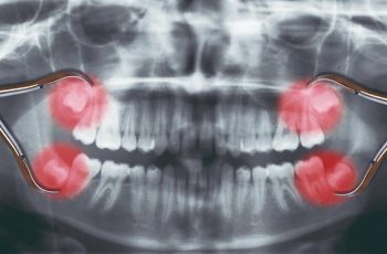 Exames de imagem dente siso