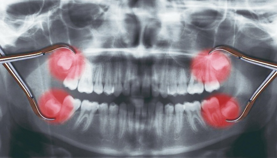 Exames de imagem dente siso - Dente Do Siso: Cuidados, Mitos E Verdades