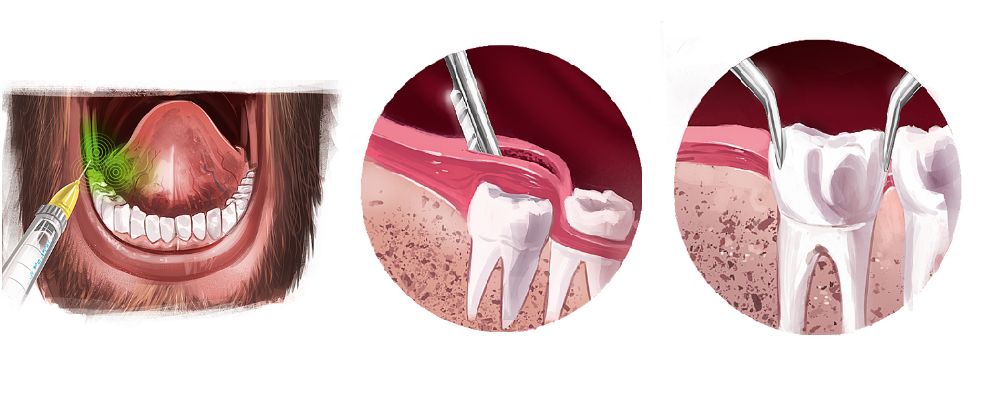 Extração De Dente Do Siso - Dente Do Siso: Cuidados, Mitos E Verdades