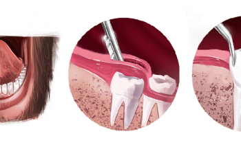 Extração De Dente Do Siso