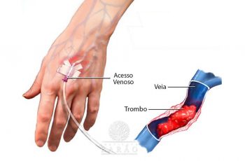 Flebite, Tipos, causas e cuidados