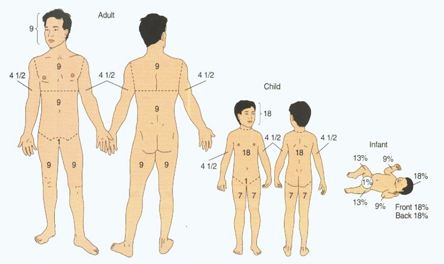 Tipos De Queimaduras