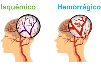 avc 3 240o 350x230 - HEMORRAGIA ARTERIAL
