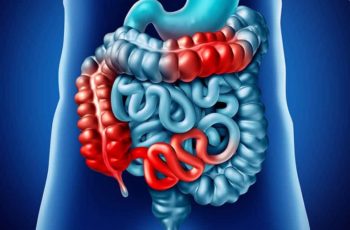 Doença de Crohn – Causas, Sintomas e Tratamento