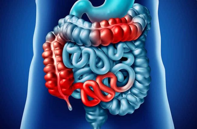 Doença de Crohn – Causas, Sintomas e Tratamento