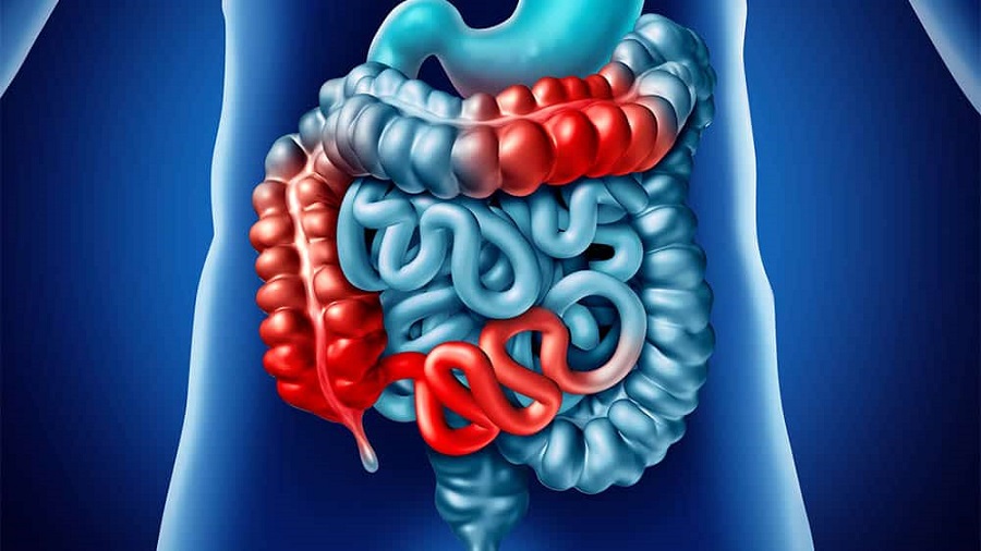 Doenca de Crohn 2 - Doença de Crohn - Causas, Sintomas e Tratamento