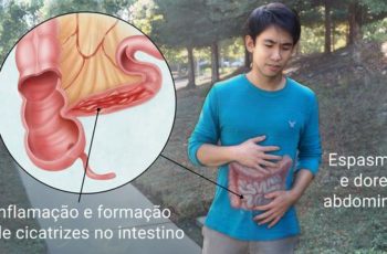 Doença de Crohn