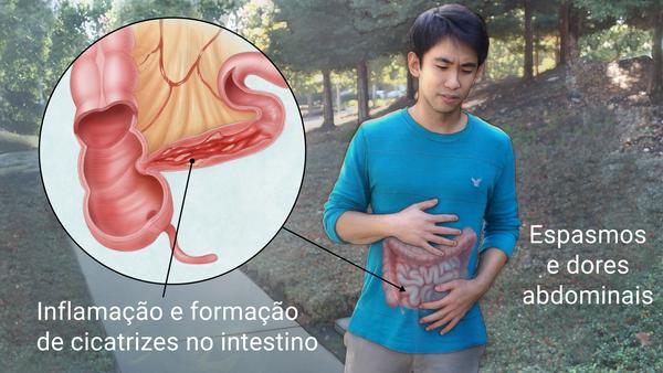Doenca de Crohn - Doença de Crohn - Causas, Sintomas e Tratamento