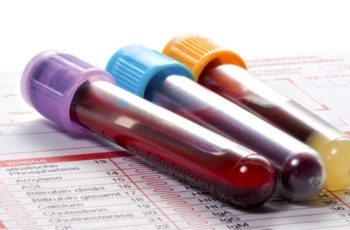 Exames para diagnosticar lúpus
