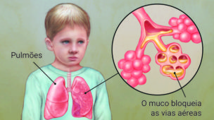 Fibrose Cística