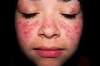 Lupus