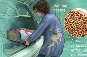 Osteoporose – Causas, Sintomas e Tratamento