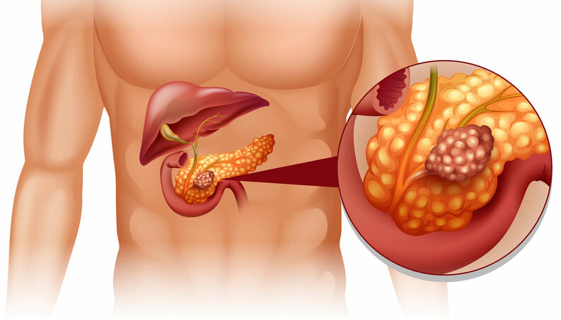 cancer de pancreas 1018 1400x800 1 - Pancreatite