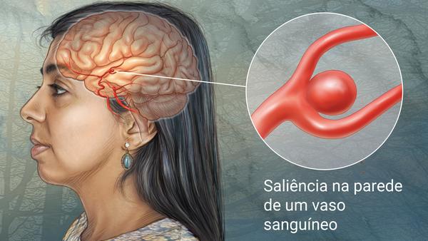 Aneurisma - O que é aneurisma cerebral?