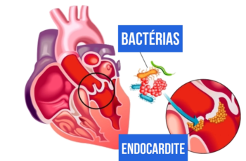 Endocardite causas, diagnóstico e tratamento