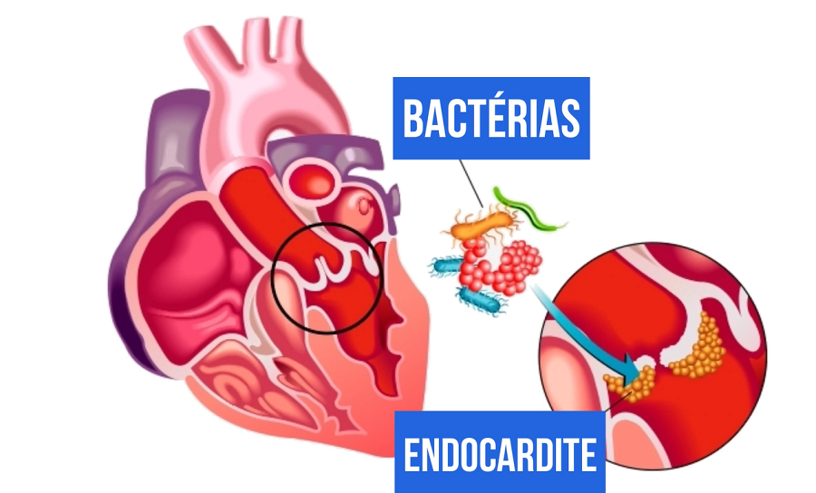 Endocardite - Endocardite causas, diagnóstico e tratamento