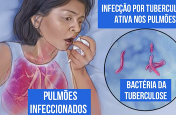Tuberculose – Causas, Sintomas e Tratamento