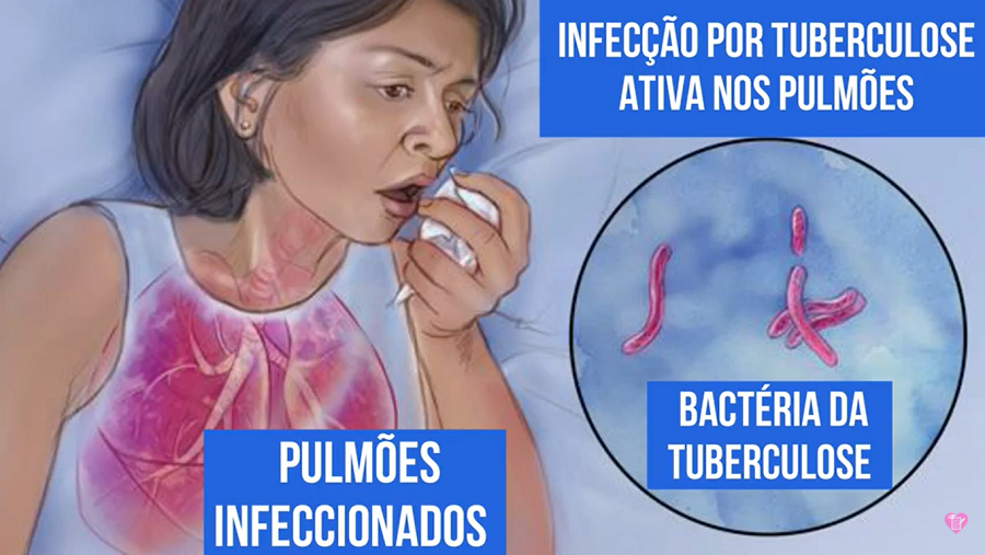 Tuberculose - Tuberculose - Causas, Sintomas e Tratamento