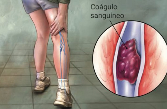 causas de la embolia pulmonar