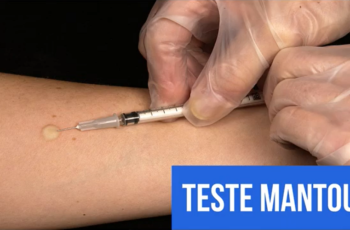 diagnostico da tuberculose 1 350x230 - exame de raio-X
