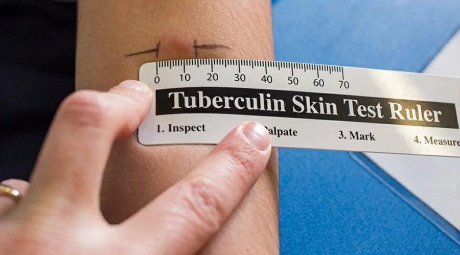 diagnostico da tuberculose 2 - Tuberculose - Causas, Sintomas e Tratamento