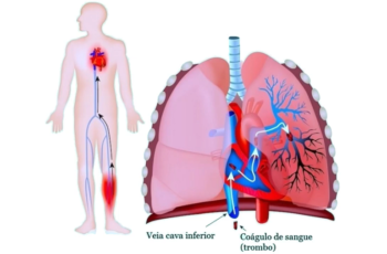 O que é embolia pulmonar?