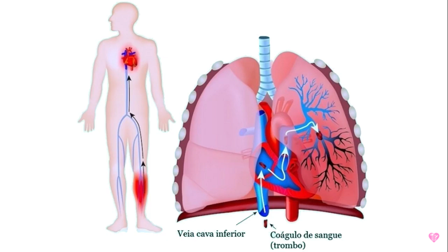 embolia pulmonar - O que é embolia pulmonar?