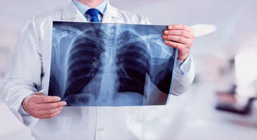 exame de raio X - O que é pneumonia? Causas e Tratamentos