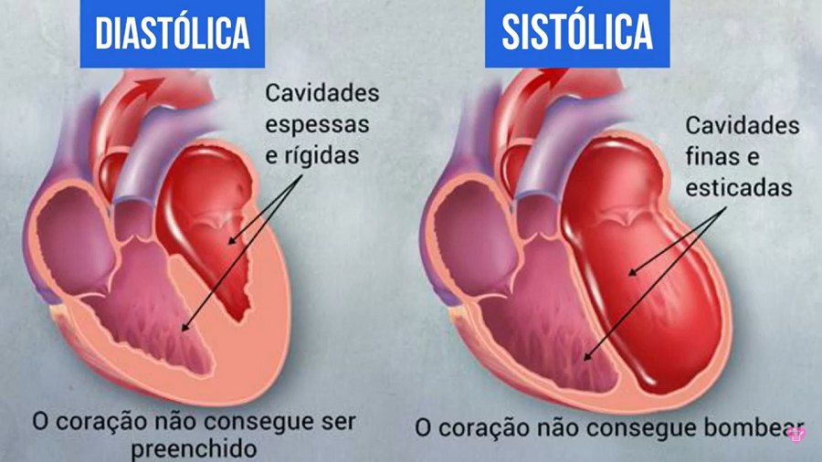 insuficiencia cardiaca - Insuficiência cardíaca - Causas e tratamentos