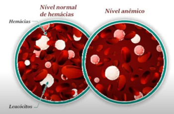 sintomas de leucemia