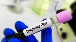 linfoma não-Hodgkin