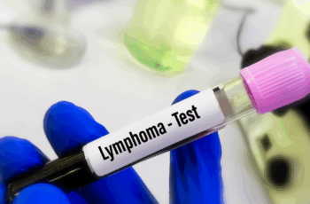 Linfoma Não-Hodgkin